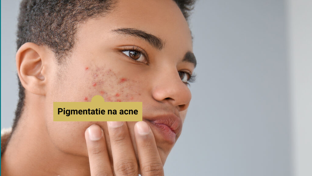 behandeling van de pigmentatie na acne